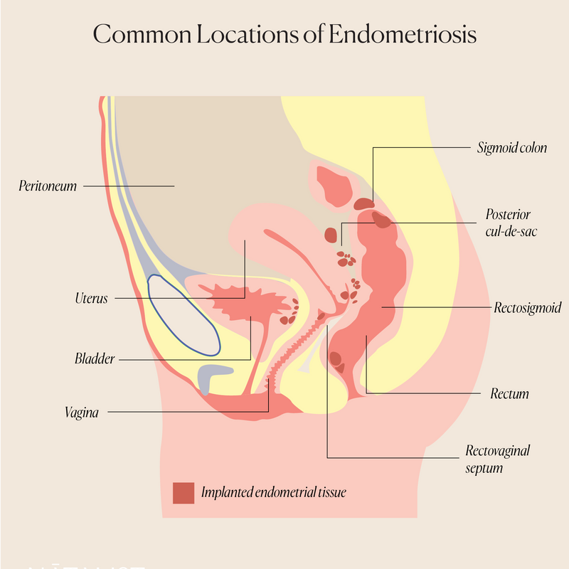 Endometriosis and Its Effect on Fertility and Pregnancy