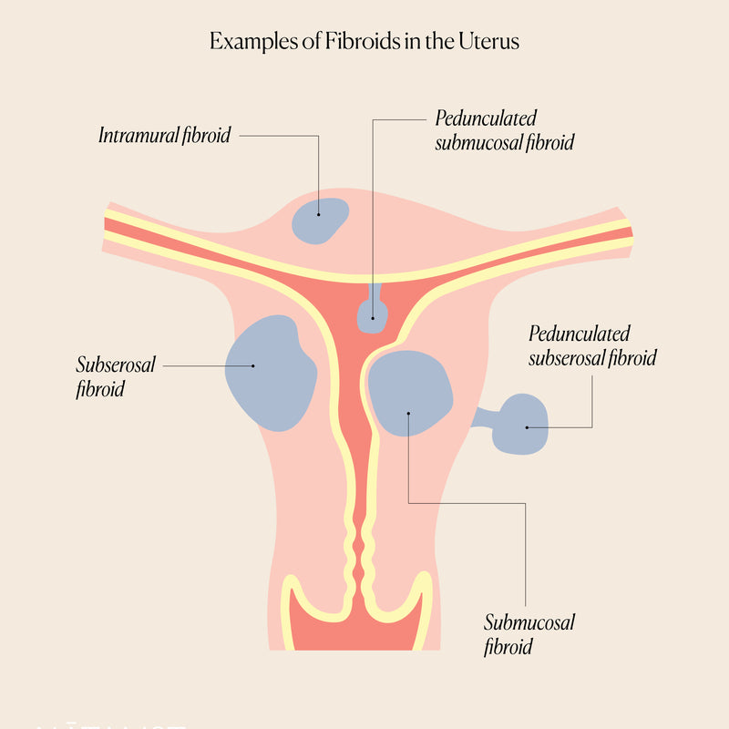 Fibroids, Fertility, and Pregnancy